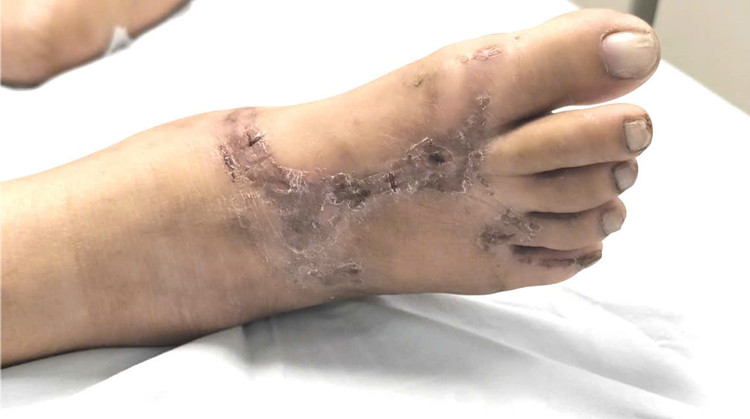 Tổn thương ở chân do bị nhiễm xoắn khuẩn vàng da - Ảnh BVCC Tổn thương ở chân do bị nhiễm xoắn khuẩn vàng da - Ảnh BVCC