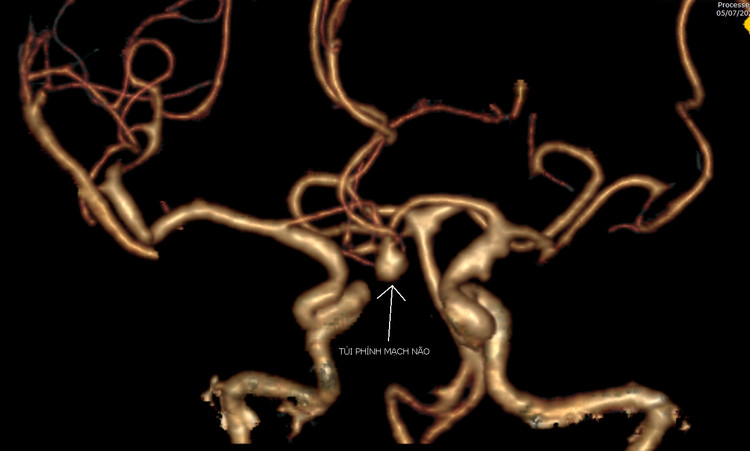 Hình ảnh túi phình mạch não của bệnh nhân Th. qua phim chụp cắt lớp vi tính dựng hình mạch não 3D
