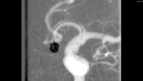 Túi phình động mạch não thông trước được coil bít lại hoàn toàn