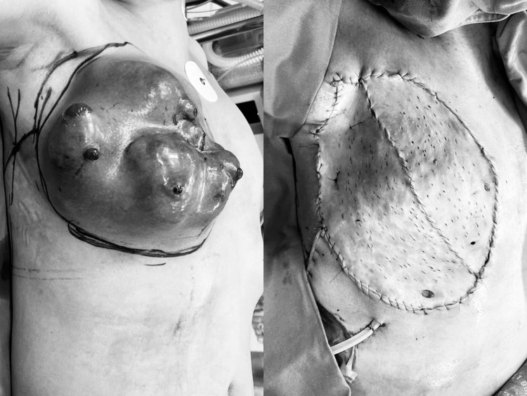 Tổn thương ung thư vú bị biến dạng hoàn toàn vùng ngực, hoại tử sâu, chảy máu ồ ạt trước và sau tạo hình - Ảnh BVCC Tổn thương ung thư vú bị biến dạng hoàn toàn vùng ngực, hoại tử sâu, chảy máu ồ ạt trước và sau tạo hình - Ảnh BVCC
