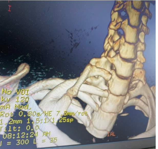 Hy hữu: Cô gái 22 tuổi có xương sườn mọc ở cổ ảnh 1