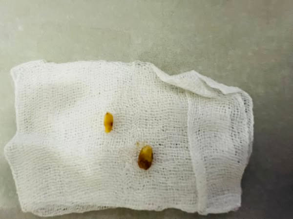 Hạt đỗ tương trong tai trẻ được lấy ra - Ảnh BVCC