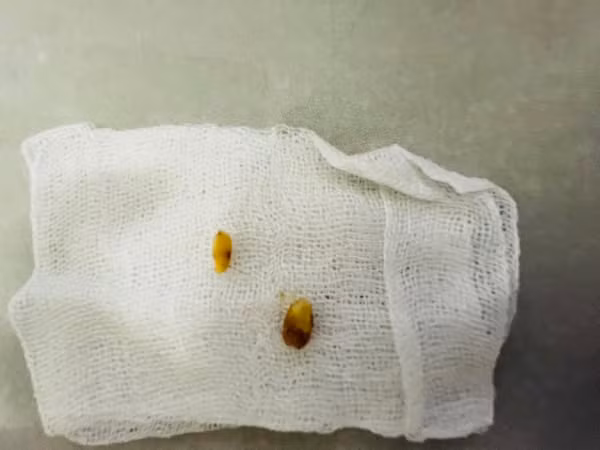 Hạt đỗ tương trong tai trẻ được lấy ra - Ảnh BVCC