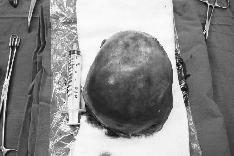 Cắt tử cung bán phần cả khối để xử lý khối chửa ngoài tử cung góc sừng trái và khối nội mạc tử cung KT 9,5x9,5 cm cho bệnh nhân - Ảnh BVCC Cắt tử cung bán phần cả khối để xử lý khối chửa ngoài tử cung góc sừng trái và khối nội mạc tử cung KT 9,5x9,5 cm cho bệnh nhân - Ảnh BVCC