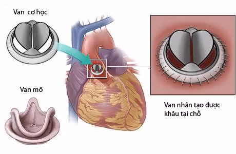 Van hai lá cơ học qua hình ảnh mô phỏng