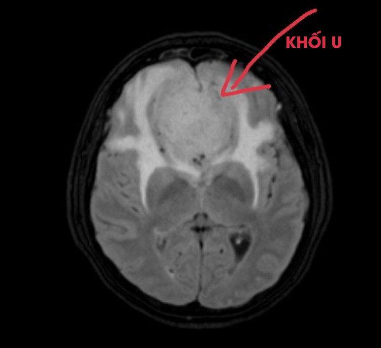 Khối u não ở trẻ trên phim chụp