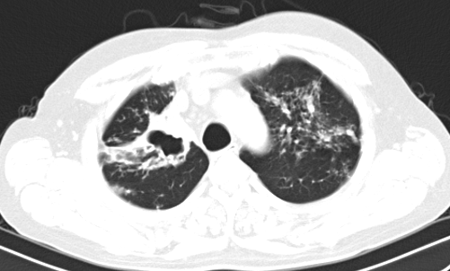Hình ảnh thâm nhiễm đỉnh phổi trái của người bệnh Đ.Q.T - Ảnh BVCC