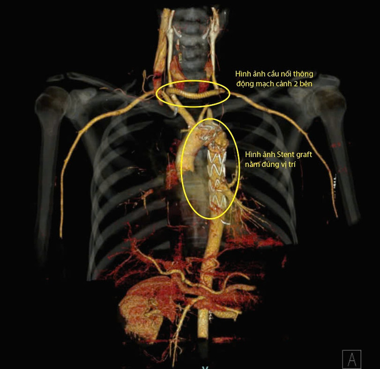 Hình ảnh động mạch chủ ngực sau khi được đặt Stent và hình ảnh cầu nối động mạch cảnh hai bên bằng mạch máu nhân tạo - Ảnh BVCC