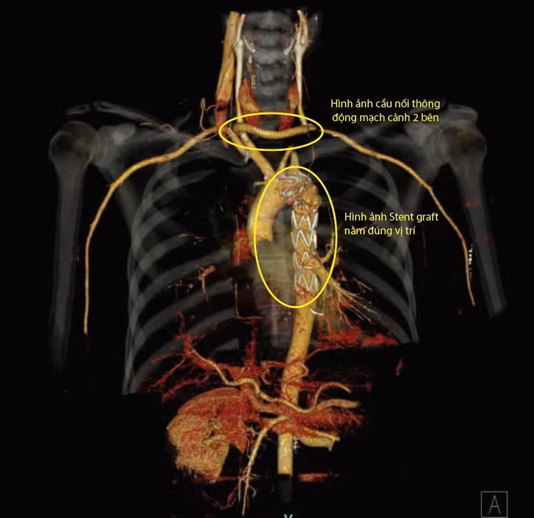 Hình ảnh động mạch chủ ngực sau khi được đặt Stent và hình ảnh cầu nối động mạch cảnh hai bên bằng mạch máu nhân tạo - Ảnh BVCC