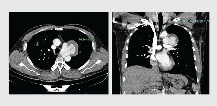Hình ảnh khối phình động mạch chủ ngực của người bệnh trên phim chụp CT - ảnh BVCC