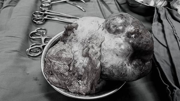 Khối u hơn 3 kg được lấy ra - Ảnh BVCC