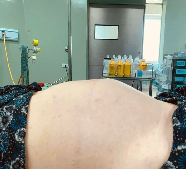 Bụng to bất ngờ do u - Ảnh BVCC