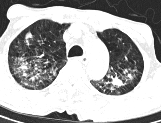 Hình ảnh X-Quang phổi của người bệnh T.X.K cho thấy hang lao đỉnh phổi trái và thâm nhiễm, xơ hoá hai đỉnh phổi - Ảnh BVCC