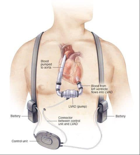 Cấy ghép tim nhân tạo hỗ trợ tâm thất LVAD