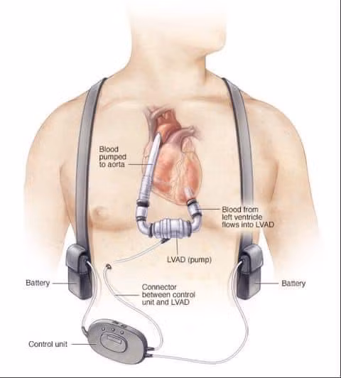 Cấy ghép tim nhân tạo hỗ trợ tâm thất LVAD