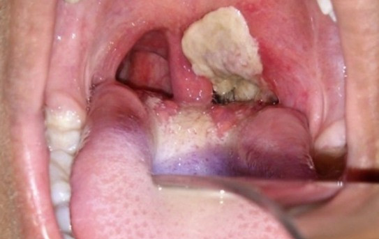 Cách phòng ngừa biến chứng nguy hiểm của bệnh bạch hầu - Ảnh BVCC