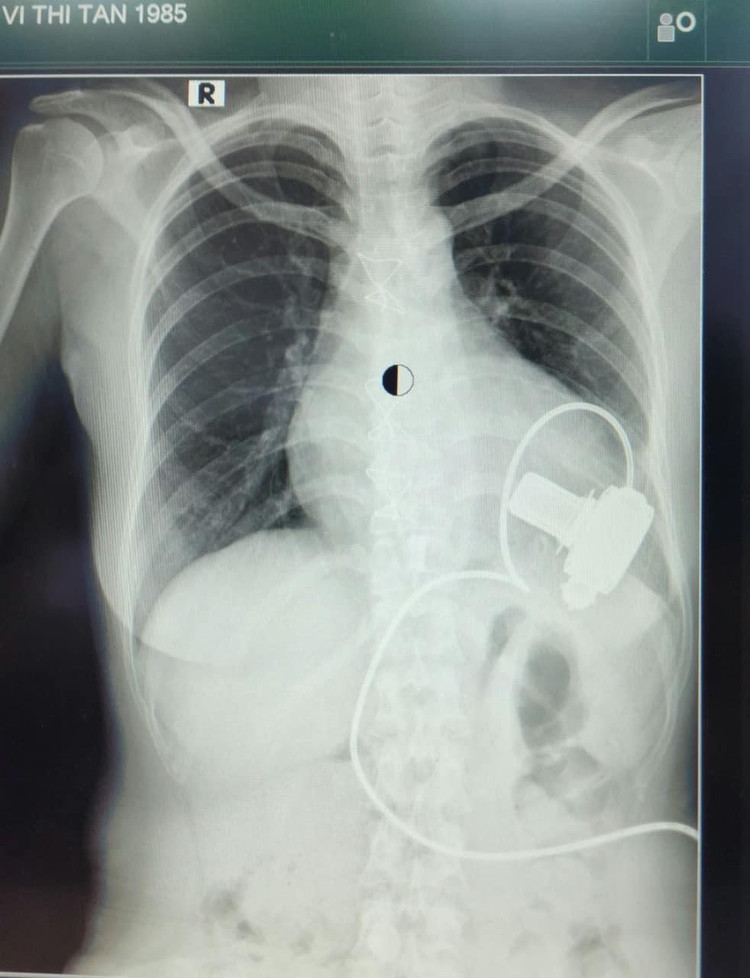 Cấy ghép tim nhân tạo hỗ trợ tâm thất LVAD ở bệnh nhân