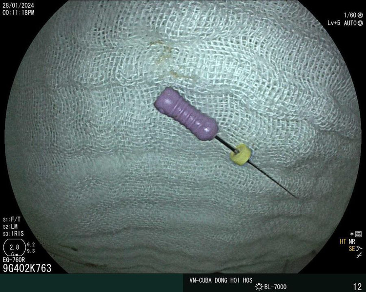 Cây kim được lấy từ ống tiêu hóa bệnh nhi ra