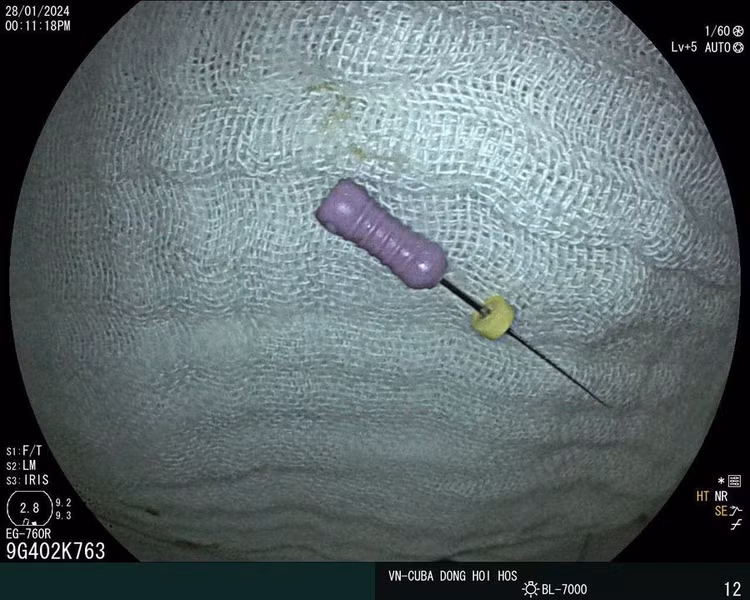 Cây kim được lấy từ ống tiêu hóa bệnh nhi ra