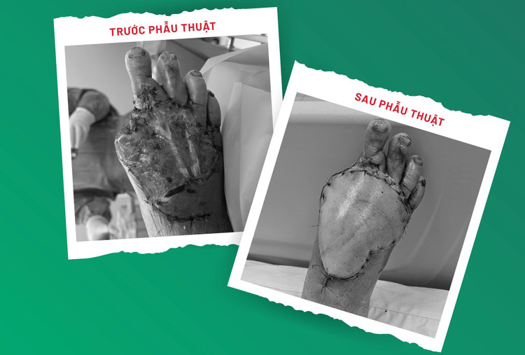 Bàn chân bệnh nhân trước và sau phẫu thuật