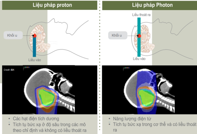 So sánh giữa liệu pháp Proton và Photon.