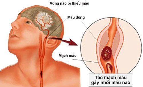 Cách ăn tránh bệnh thiểu năng tuần hoàn não gây tai biến