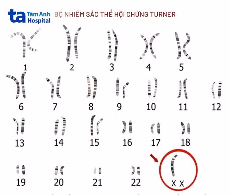 mo-phong-nhiem-sac-the-bi-loi-cua-hoi-chung-turner.jpg