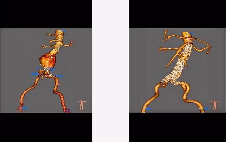 stent.jpg