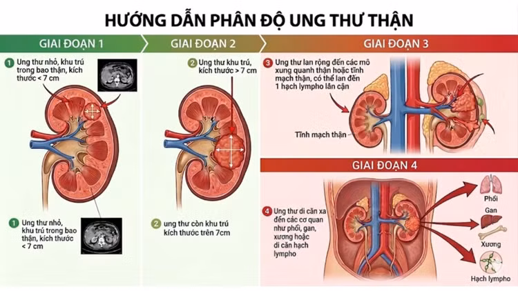 ung-thu-than1.jpg