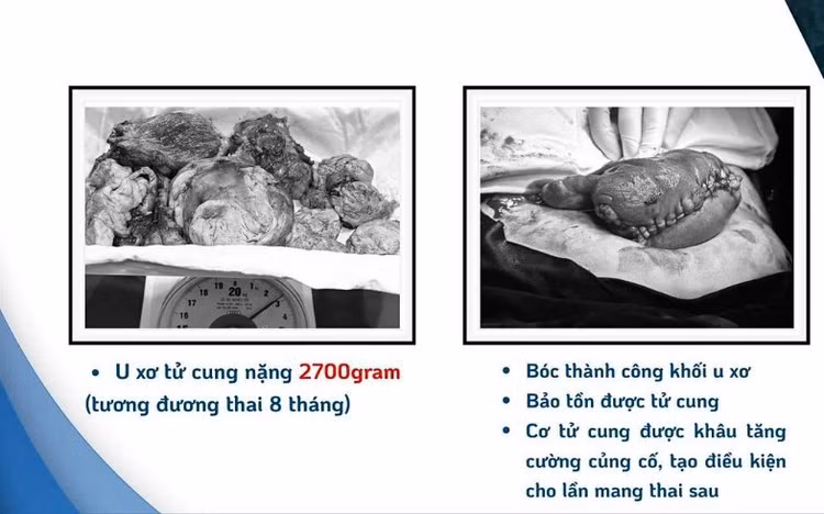 u-xo-tu-cung-kh.jpg