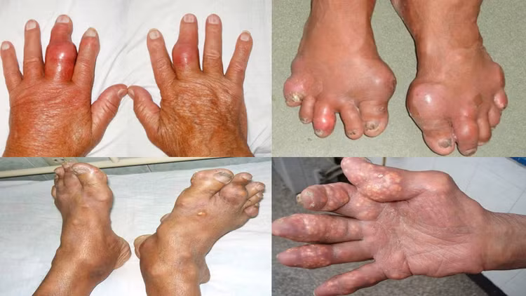 bien-chung-benh-gout2.jpg