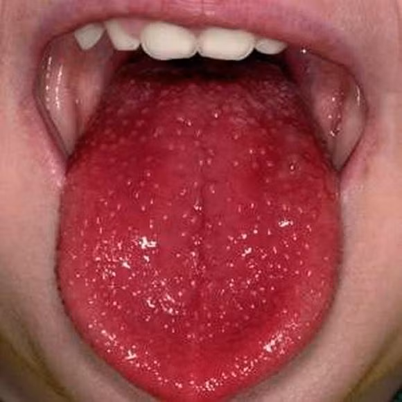 benh-tre-2.jpg
