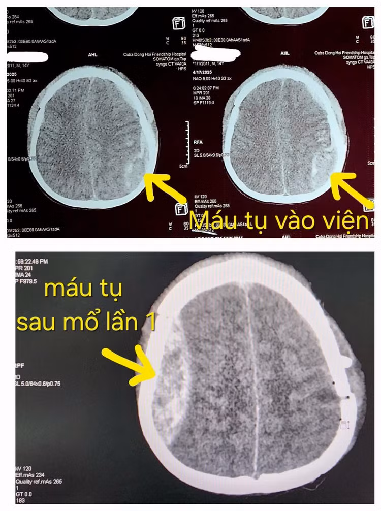 2-lan-mo-nao-1.jpg