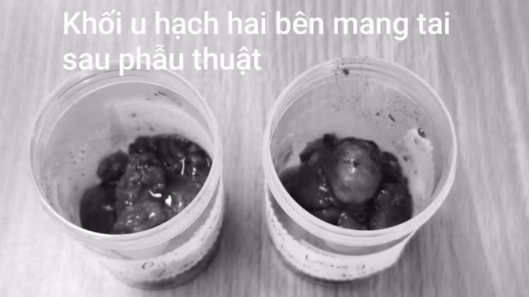 khoi-u-mang-tai.jpg