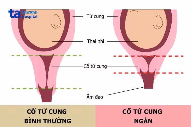 so-sanh-co-tu-cung-binh-thuong-va-ngan.jpg