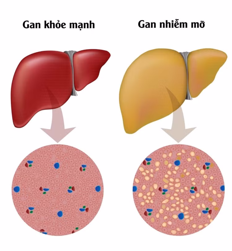 gan-nhiem-mo.jpg