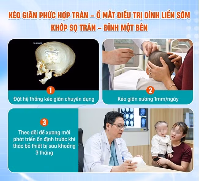 keo-dan-2.jpg