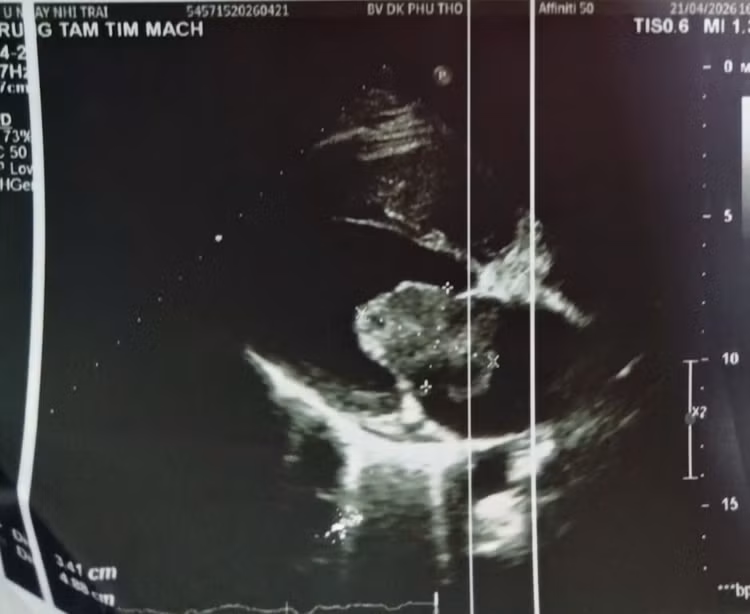 u-nhay-tim-2.jpg