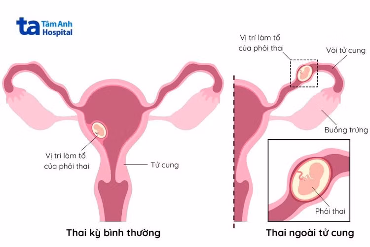 cac-truong-hop-thai-ngoai-tu-cung.jpg