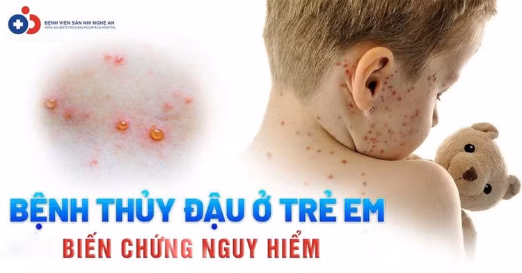 thuy-dau-ac-tih.jpg