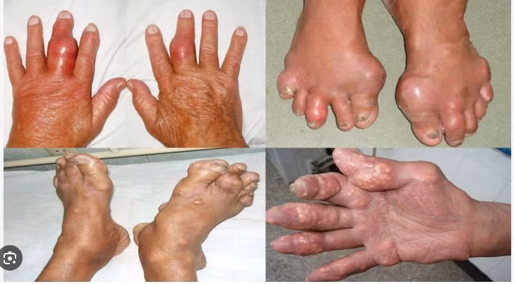 benh-gout.jpg