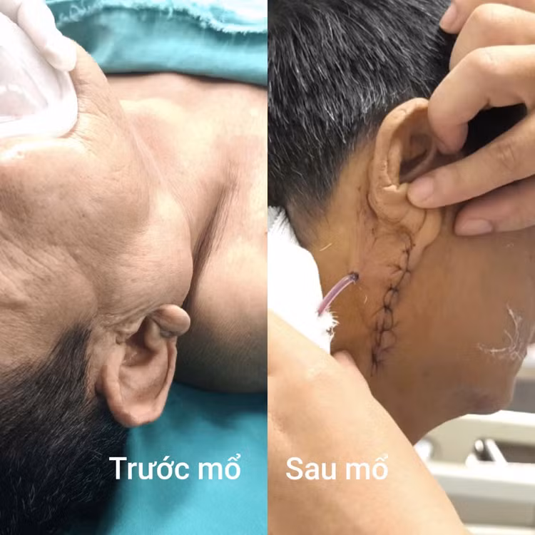 u-tuyen-nuoc-bot.jpg