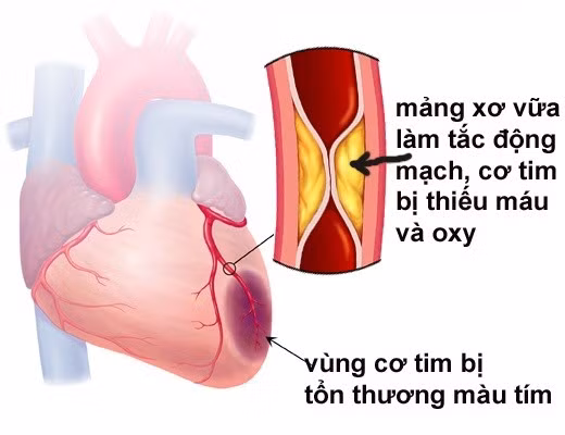 nhoi-mau1.jpg