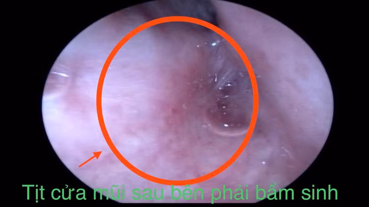 tit-cua-mui-2.jpg