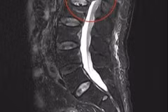 Tổn thương tủy sống do loãng xương gây xẹp đốt sống dễ liệt chi