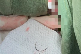 Gắp kim khâu nằm trong tầng sinh môn người phụ nữ suốt 11 năm