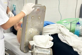 Kẹt nguyên bàn tay trong máy xay thịt, người phụ nữ phải cắt cụt chi