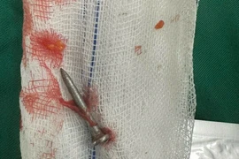 Súng bắn đinh bắn xuyên thành bụng, găm thủng ruột non