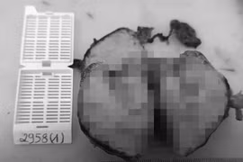 Khỏe mạnh đi khám phát hiện u ác tuyến ức