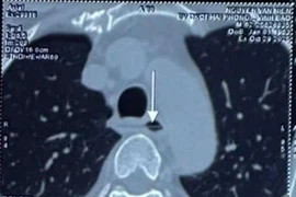 Ca cấp cứu nghẹt thở, dị vật sắc nhọn xuyên thực quản, sát động mạch chủ